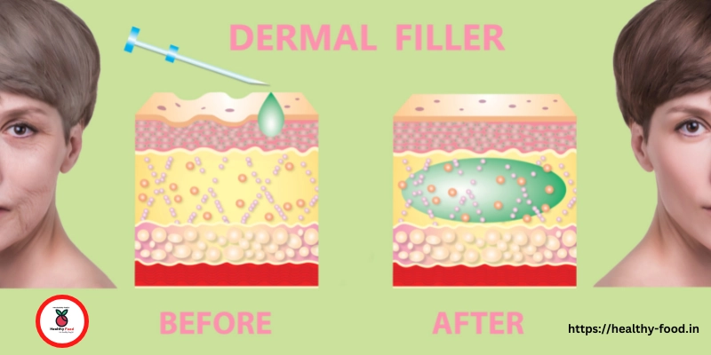 Cheek Apple Filler Before and After