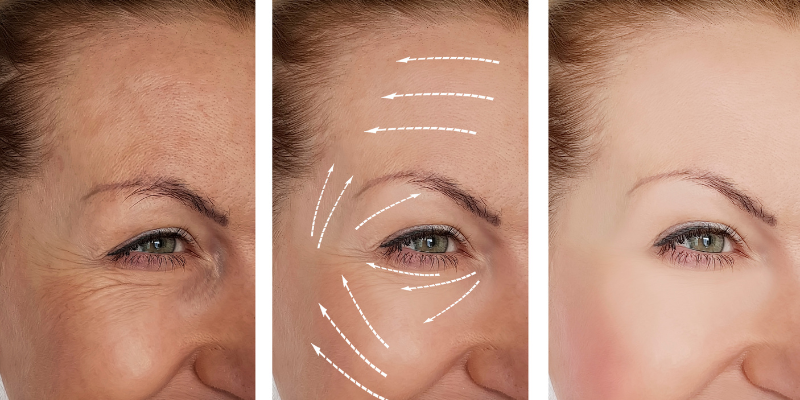Cheek Filler Before and After Images