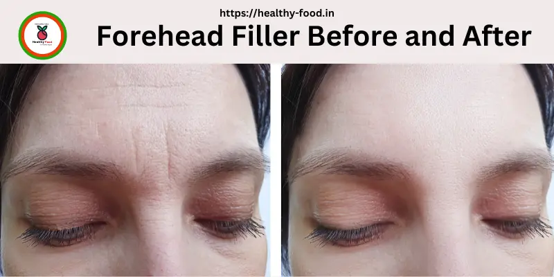 Forehead Filler Before and After