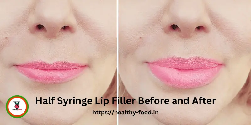 Half Syringe Lip Filler Before and After