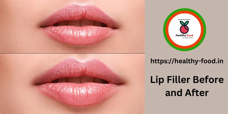 Lip Filler Before and After