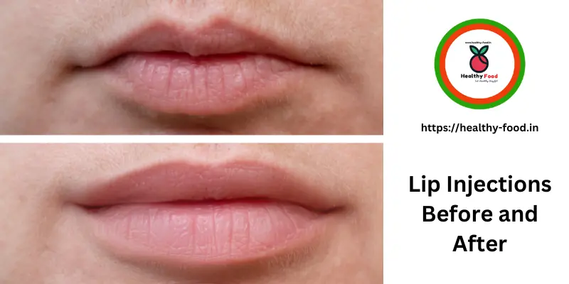 Lip Injections Before and After