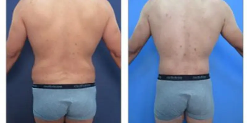 Male BBL Brazilian Butt Lift Before and After
