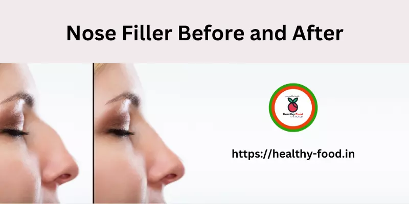 Nose Filler Before and After