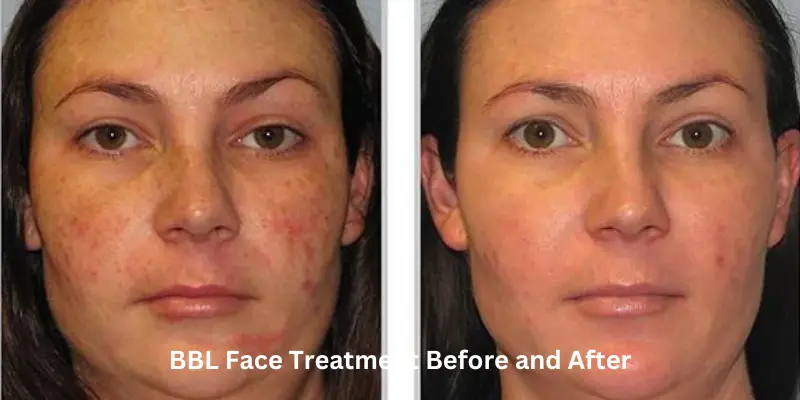 BBL Face Treatment Before and After 2